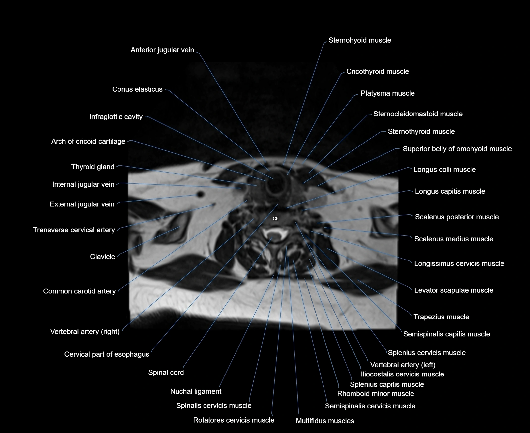 MRI Neck 3D labelled cross section anatomy axial 3t image-00001-00068.webp
